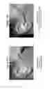Fig. 11 - Device, system and method for reducing headache pain