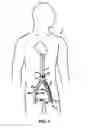 Fig. 02 - Device and method for establishing an artificial arterio-venous fistula