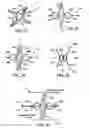 Fig. 09 - Device and method for establishing an artificial arterio-venous fistula