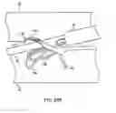 Fig. 16 - Device and method for establishing an artificial arterio-venous fistula