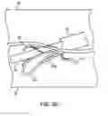 Fig. 17 - Device and method for establishing an artificial arterio-venous fistula