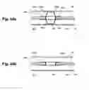 Fig. 23 - Device and method for establishing an artificial arterio-venous fistula