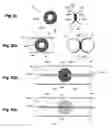 Fig. 28 - Device and method for establishing an artificial arterio-venous fistula