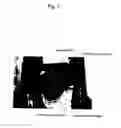 Fig. 08 - Abnormal electrical conduction blocking apparatus using photodynamic therapy (PDT)