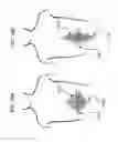 Fig. 18 - METHODS AND DEVICES TO DECREASE TISSUE TRAUMA DURING SURGERY