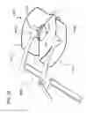 Fig. 27 - METHODS AND DEVICES TO DECREASE TISSUE TRAUMA DURING SURGERY