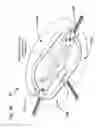 Fig. 47 - METHODS AND DEVICES TO DECREASE TISSUE TRAUMA DURING SURGERY