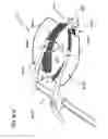 Fig. 55 - METHODS AND DEVICES TO DECREASE TISSUE TRAUMA DURING SURGERY