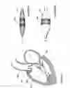 Fig. 65 - Inflatable medical devices