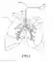 Fig. 04 - Delivery devices with coolable energy emitting assemblies