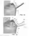 Fig. 03 - SYSTEM AND METHOD FOR FORMING A CURVED TUNNEL IN BONE