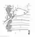 Fig. 16 - Surgical retrieval apparatus for thoracic procedures