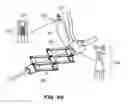Fig. 93 - Systems and methods for positioning an elongate member inside a body