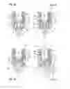 Fig. 09 - Polyaxial bone anchoring device with enlarged pivot angle