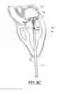 Fig. 22 - Adjustable heart valve implant