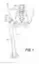 Fig. 02 - PROSTHETIC PLACEMENT TOOL AND ASSOCIATED METHODS