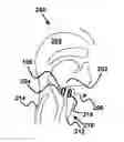 Fig. 01 - Device and method for correcting obstructive sleep apnea