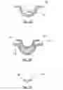 Fig. 05 - Method of manufacturing hydrogel ophthalmic devices with electronic elements