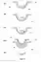 Fig. 04 - Method and apparatus for encapsulating a rigid insert in a contact lens for correcting vision in astigmatic patients