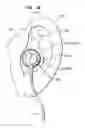 Fig. 08 - Double seal moldable earpiece system