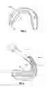 Fig. 04 - ONE VISIT DENTURE