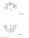 Fig. 04 - DENTAL BRIDGE ATTACHMENT SYSTEM AND METHOD