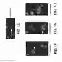 Fig. 05 - METHOD FOR DETERMINING DISEASE SEVERITY IN TAUOPATHY-RELATED NEURODEGENERATIVE DISORDERS
