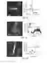 Fig. 05 - Coatings of semiconductor quantum dots for improved visibility of electrodes and pipettes