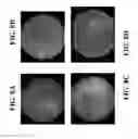Fig. 08 - Methods for Inhibiting or Reversing Epiretinal Membrane Formation