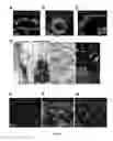 Fig. 15 - COMPOSITIONS AND METHODS FOR DIAGNOSIS AND THERAPY OF DISORDERS RELATED TO ALTERATIONS OF MYH9