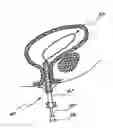 Fig. 01 - Method of removing an inflated implant from a bladder