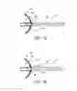 Fig. 08 - Method of removing an inflated implant from a bladder