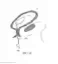 Fig. 22 - Method of removing an inflated implant from a bladder