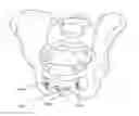 Fig. 01 - INCONTINENCE IMPLANT, INSERTION DEVICE AND RELATED METHODS OF USE