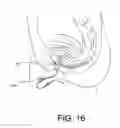 Fig. 09 - INCONTINENCE IMPLANT, INSERTION DEVICE AND RELATED METHODS OF USE