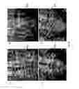 Fig. 35 - NEURO-PROBE DEVICE, IMPLANTABLE ELECTRONIC DEVICE AND METHOD OF FORMING A NEURO-PROBE DEVICE