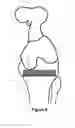 Fig. 09 - DETERMINING A RANGE OF MOTION OF AN ARTIFICIAL KNEE JOINT