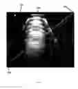 Fig. 07 - Surgical needle for a surgical system with optical recognition