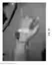 Fig. 03 - ISOLATED ORTHOSIS FOR THUMB ACTUATION
