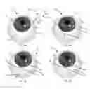 Fig. 05 - Methods, systems and devices for treating glaucoma