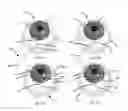 Fig. 06 - Methods, systems and devices for treating glaucoma