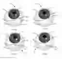 Fig. 07 - Methods, systems and devices for treating glaucoma