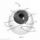 Fig. 08 - Methods, systems and devices for treating glaucoma
