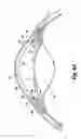 Fig. 06 - Shunt device and method for treating ocular disorders