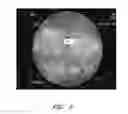 Fig. 03 - Apparatuses and methods for wound therapy