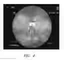 Fig. 05 - Apparatuses and methods for wound therapy