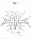 Fig. 05 - Apparatus and method for performing intrastromalabdominal hysterectomy as bloodless nerve sparing method