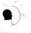 Fig. 04 - System for Inserting an Intracorneal Lens