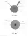 Fig. 35 - Removable deployment device, system, and method for implantable prostheses