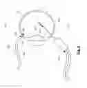 Fig. 04 - Pressure-sensing vitrectomy surgical systems and methods